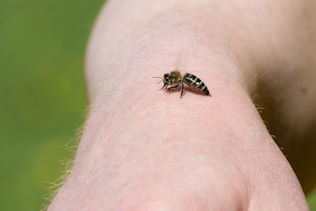 Biene auf Haut sinnbildlich für Insektenstiche-Parapic